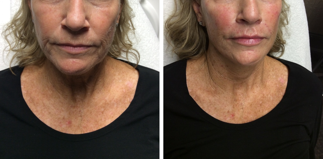 Juvederm treatment results in visible reduction of wrinkles in before and after photos of a woman.
