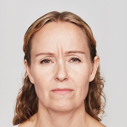 Dysport | ﻿﻿Irvine Medical Spa