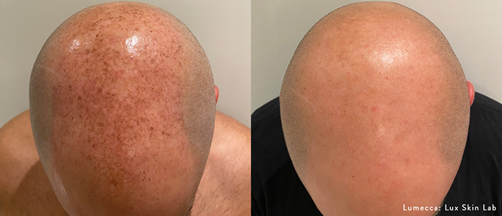 LuxSkinLab_Lumecca_1_1txScalp