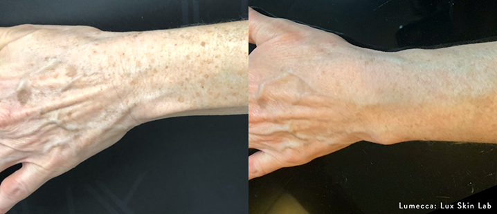 LuxSkinLab_Lumecca_2_1txHand