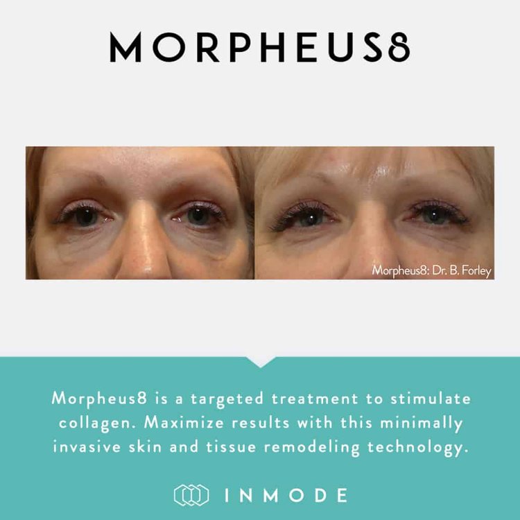 Morpheus8_BeforeAndAfter_SocialPost-1-1030x1030