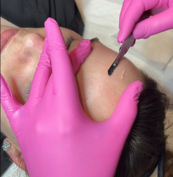 Micro needling Pen