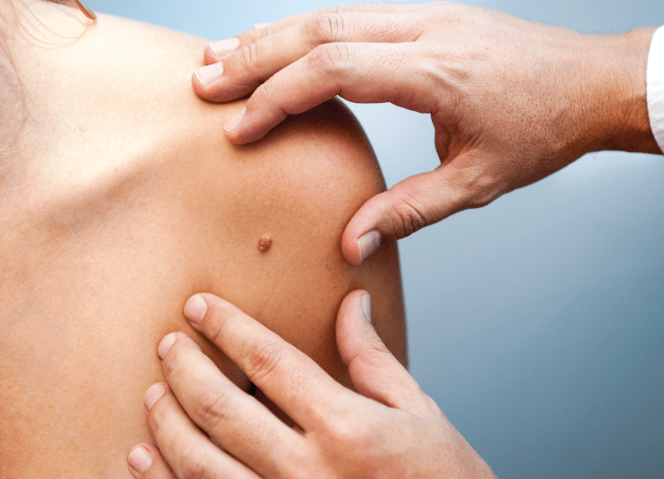 Types of Moles and How to Identify