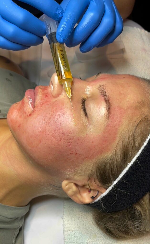 Skin Treatment, Microneedling